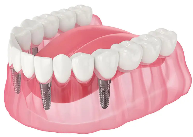 Dental Implants