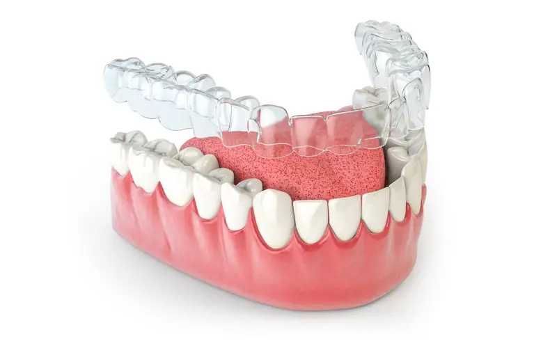 Invisalign®