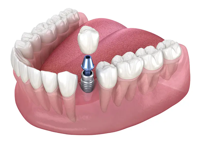 Single Tooth Implants